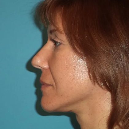Facelift Before & After Patient #421