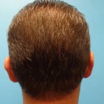 Otoplasty Ear Pinning Before & After Patient #614
