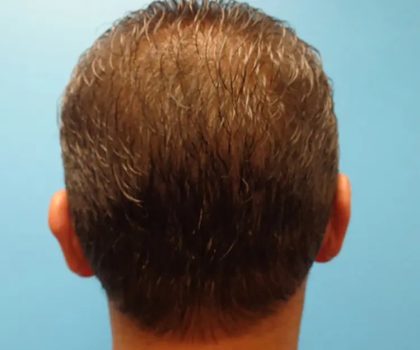 Otoplasty Ear Pinning Before & After Patient #614