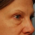 Blepharoplasty Before & After Patient #143