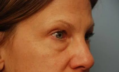 Blepharoplasty Before & After Patient #143