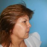 Brow Lift Before & After Patient #331
