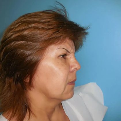 Brow Lift Before & After Patient #331