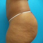 Coolsculpting Before & After Patient #351
