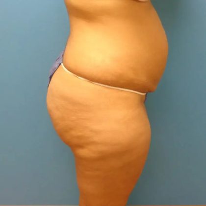 Tummy Tuck Before & After Patient #95