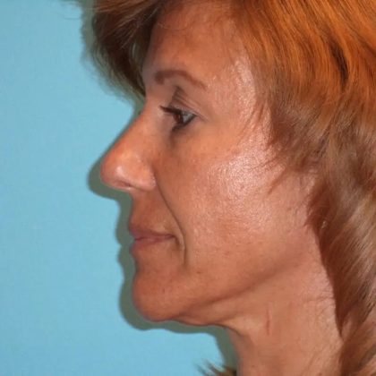Facelift Before & After Patient #421