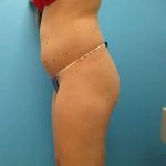Liposuction Before & After Patient #496
