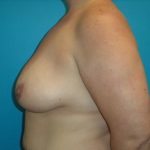 Breast Lift Before & After Patient #544