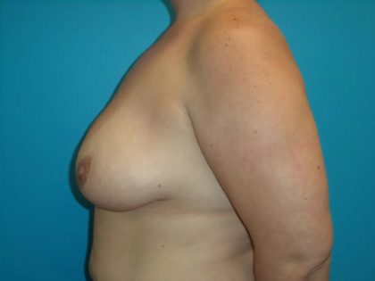 Breast Lift Before & After Patient #544