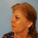 Brow Lift Before & After Patient #331