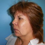Brow Lift Before & After Patient #331