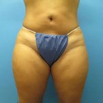Liposuction Before & After Patient #501