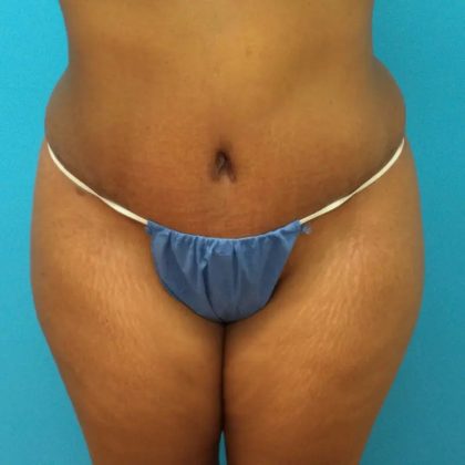 Tummy Tuck Before & After Patient #100