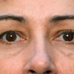 Brow Lift Before & After Patient #334
