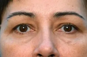 Brow Lift Before & After Patient #334