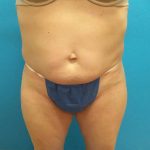 Coolsculpting Before & After Patient #358