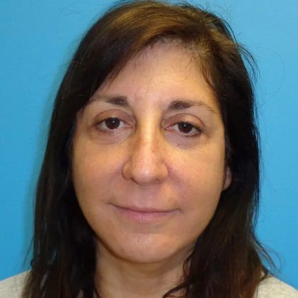 Facelift Before & After Patient #426