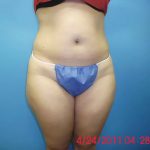 Liposuction Before & After Patient #501