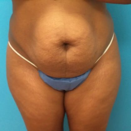 Tummy Tuck Before & After Patient #100