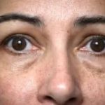 Brow Lift Before & After Patient #334