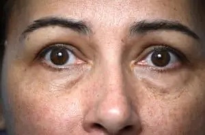 Brow Lift Before & After Patient #334