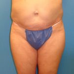 Coolsculpting Before & After Patient #358