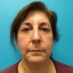 Facelift Before & After Patient #426