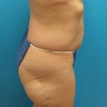 Coolsculpting Before & After Patient #358