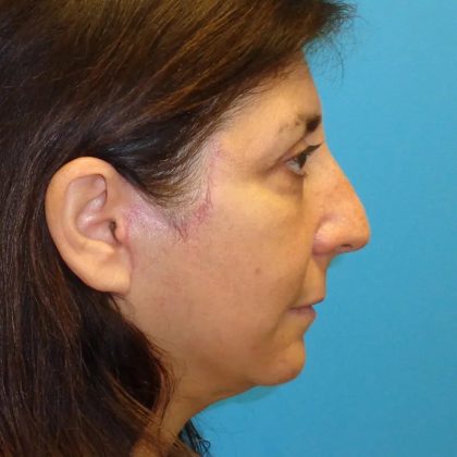 Facelift Before & After Patient #426