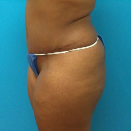 Tummy Tuck Before & After Patient #100
