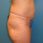 Coolsculpting Before & After Patient #358