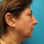 Facelift Before & After Patient #426