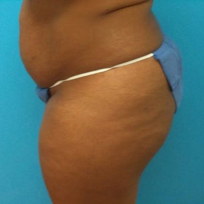 Tummy Tuck Before & After Patient #100