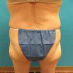 Coolsculpting Before & After Patient #358