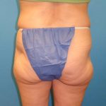 Coolsculpting Before & After Patient #358