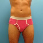 Coolsculpting Before & After Patient #365
