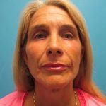 Facelift Before & After Patient #429