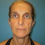 Facelift Before & After Patient #429