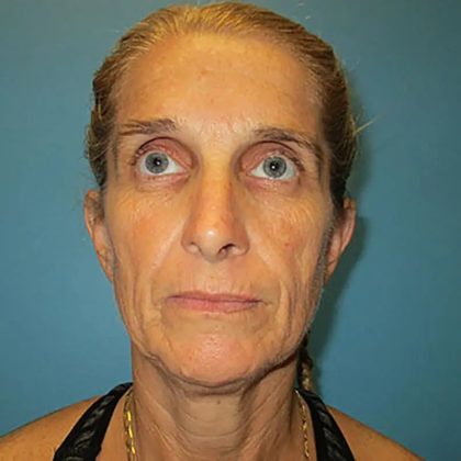 Facelift Before & After Patient #429
