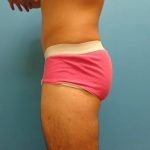 Coolsculpting Before & After Patient #365