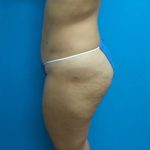 Liposuction Before & After Patient #506