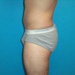 Coolsculpting Before & After Patient #365