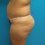 Liposuction Before & After Patient #506