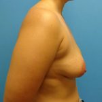 Breast Lift Before & After Patient #554