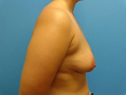 Breast Lift Before & After Patient #554