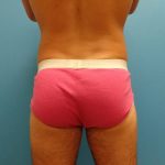 Coolsculpting Before & After Patient #365