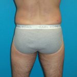 Coolsculpting Before & After Patient #365