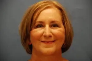 Facelift Before & After Patient #432