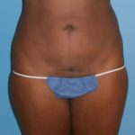 Liposuction Before & After Patient #511
