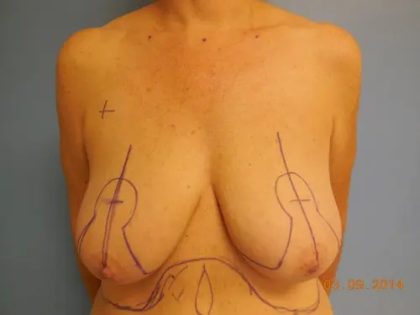 Breast Lift Before & After Patient #563